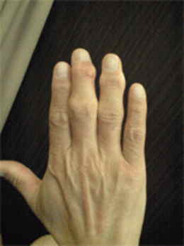 指の変形　治療後