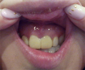 歯茎の腫れ　治療後