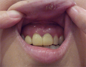 歯茎の腫れ　治療前